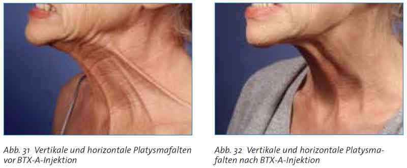 vertikale-und-horizontale-platysmafalten.jpg