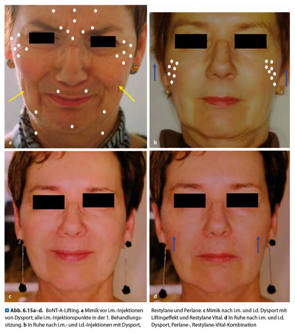 full-face-lifting-effekt.jpg